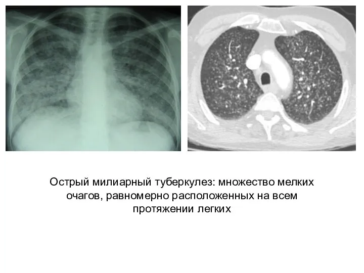 Острый милиарный туберкулез: множество мелких очагов, равномерно расположенных на всем протяжении легких