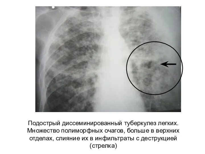 Подострый диссеминированный туберкулез легких. Множество полиморфных очагов, больше в верхних отделах, слияние их