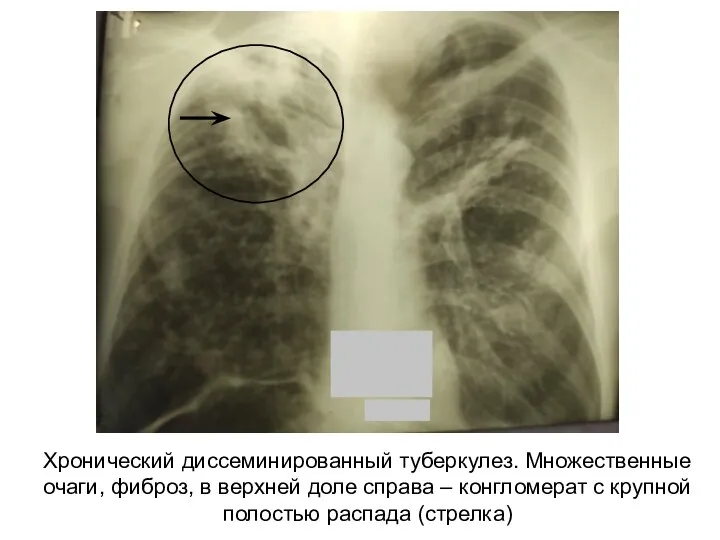 Хронический диссеминированный туберкулез. Множественные очаги, фиброз, в верхней доле справа – конгломерат с