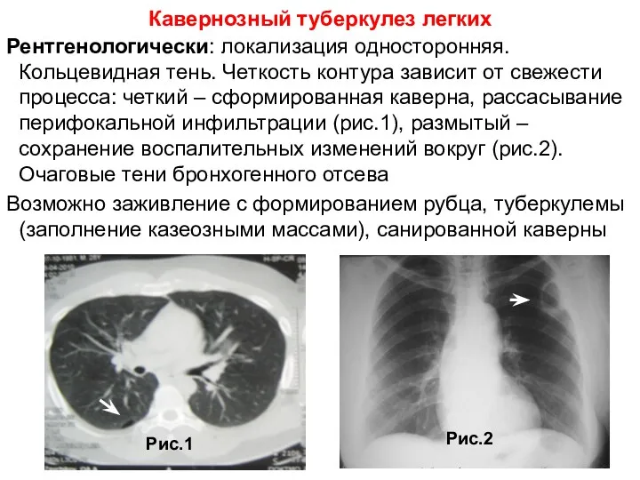 Рентгенологически: локализация односторонняя. Кольцевидная тень. Четкость контура зависит от свежести процесса: четкий –