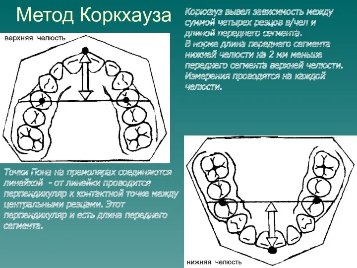 Метод Коркхауза Коркхауз вывел зависимость между суммой четырех резцов в/чел