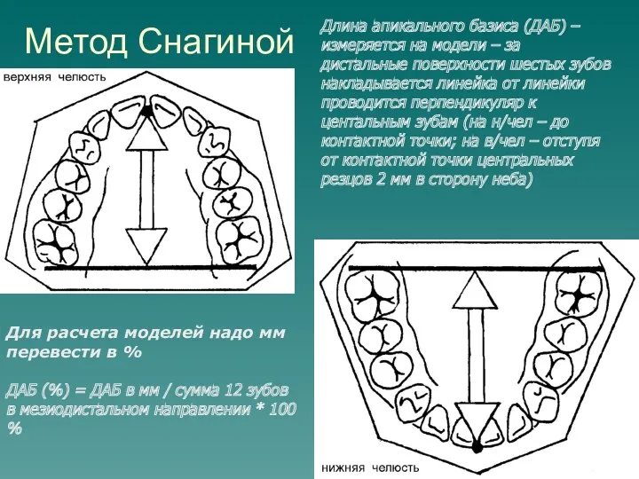 Метод Снагиной Длина апикального базиса (ДАБ) – измеряется на модели