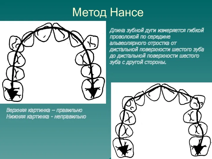 Метод Нансе Длина зубной дуги измеряется гибкой проволокой по середине