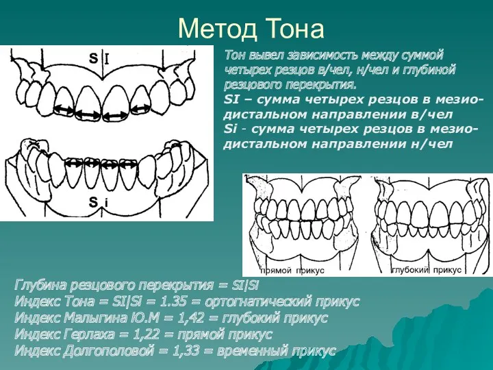 Метод Тона Глубина резцового перекрытия = SI|Si Индекс Тона =