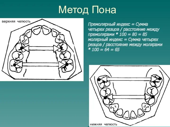 Метод Пона Премолярный индекс = Сумма четырех резцов / расстояние