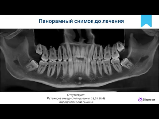 POLNYY PORYADOK Панорамный снимок до лечения Отсутствуют: Ретенированы/дистопированы: 18,28,38,48 Эндодонтически лечены: