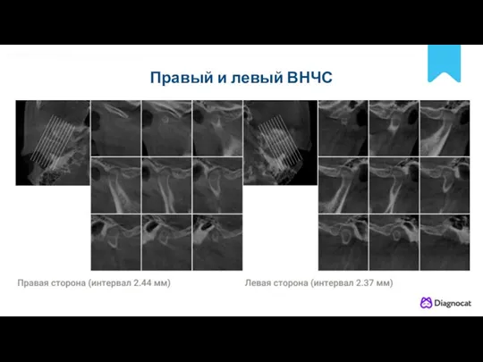 POLNYY PORYADOK Правый и левый ВНЧС