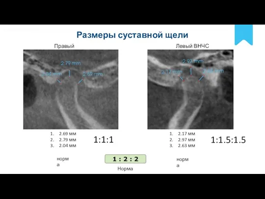 POLNYY PORYADOK Размеры суставной щели Правый ВНЧС Левый ВНЧС 2.69