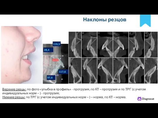 POLNYY PORYADOK Наклоны резцов Верхние резцы: по фото «улыбка в