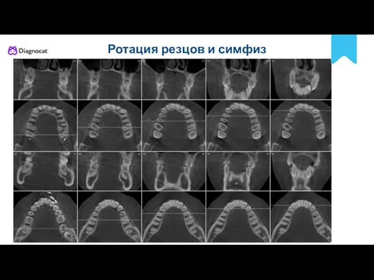 POLNYY PORYADOK Ротация резцов и симфиз