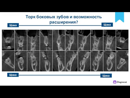 POLNYY PORYADOK Щека Щека Щека Щека Торк боковых зубов и возможность расширения?