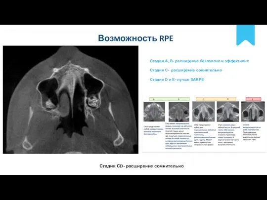 POLNYY PORYADOK Возможность RPE Стадия A, B- расширение безопасно и