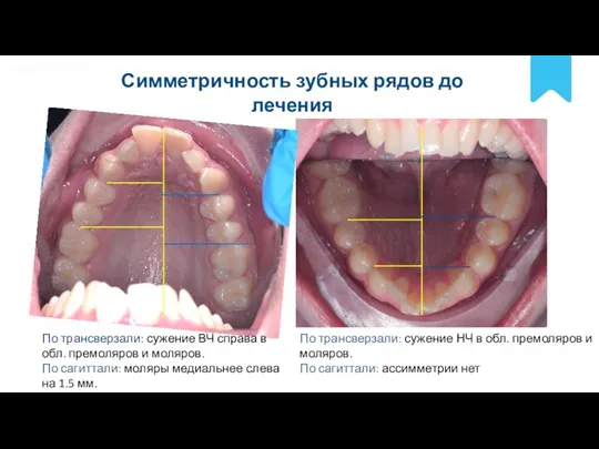 POLNYY PORYADOK Симметричность зубных рядов до лечения По трансверзали: сужение