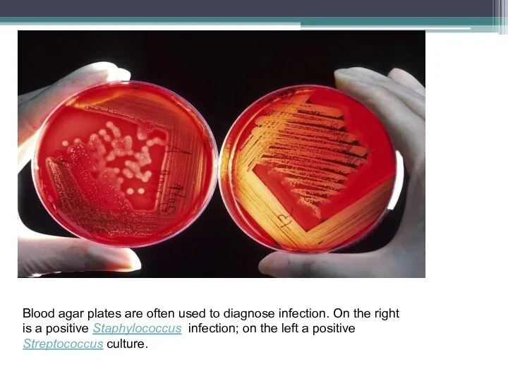 Blood agar plates are often used to diagnose infection. On