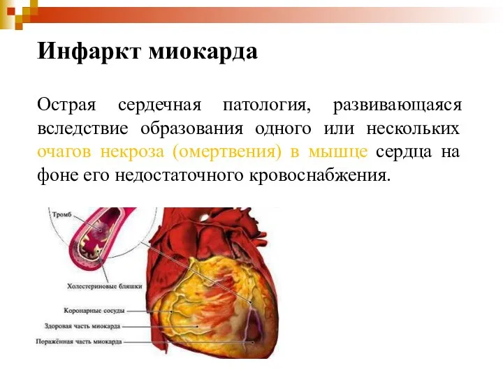 Инфаркт миокарда Острая сердечная патология, развивающаяся вследствие образования одного или