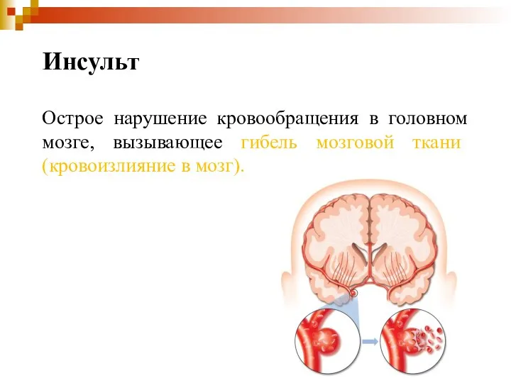Инсульт Острое нарушение кровообращения в головном мозге, вызывающее гибель мозговой ткани (кровоизлияние в мозг).