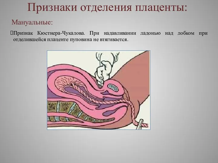 Мануальные: Признак Кюстнера-Чукалова. При надавливании ладонью над лобком при отделившейся