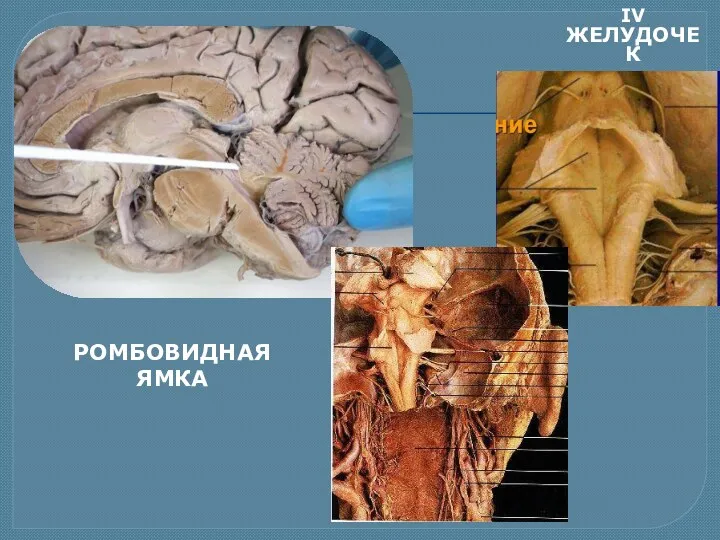 РОМБОВИДНАЯ ЯМКА IV ЖЕЛУДОЧЕК