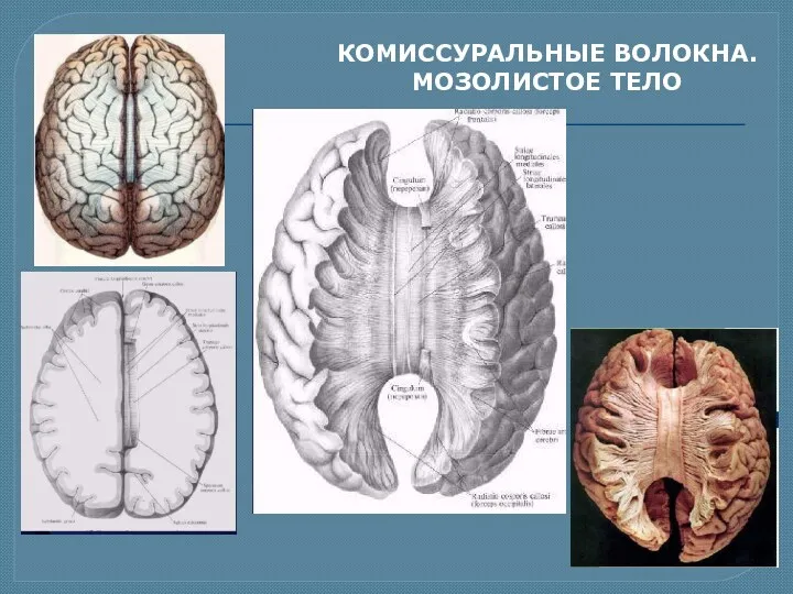 КОМИССУРАЛЬНЫЕ ВОЛОКНА. МОЗОЛИСТОЕ ТЕЛО