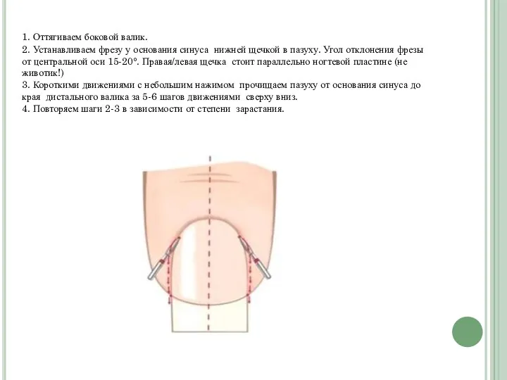 1. Оттягиваем боковой валик. 2. Устанавливаем фрезу у основания синуса