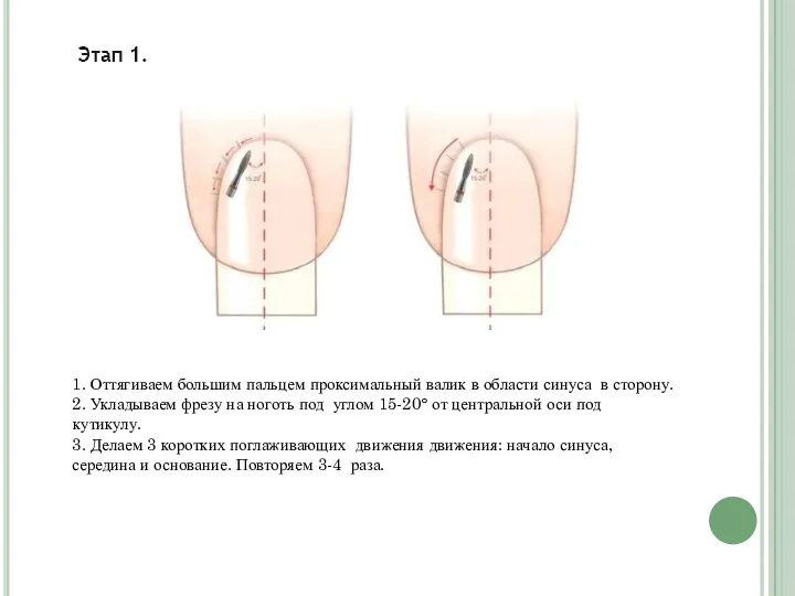 1. Оттягиваем большим пальцем проксимальный валик в области синуса в