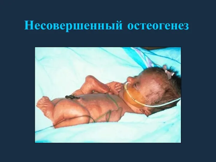 Несовершенный остеогенез