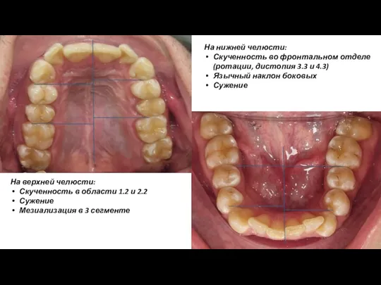 На нижней челюсти: Скученность во фронтальном отделе (ротации, дистопия 3.3