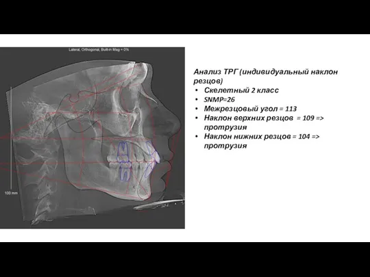 Анализ ТРГ (индивидуальный наклон резцов) Скелетный 2 класс SNMP=26 Межрезцовый