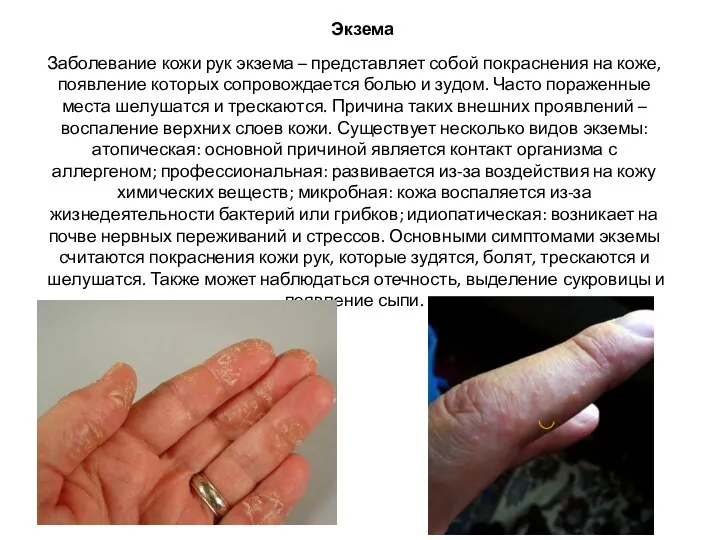 Экзема Заболевание кожи рук экзема – представляет собой покраснения на