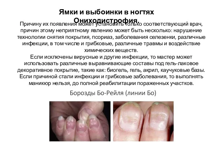 Ямки и выбоинки в ногтях Ониходистрофия. Причину их появления может