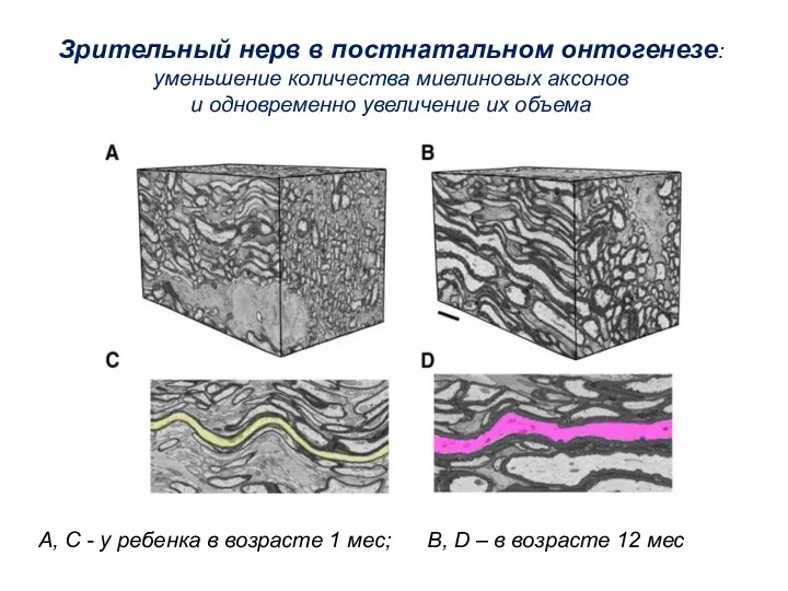 Зрительный нерв в постнатальном онтогенезе: уменьшение количества миелиновых аксонов и