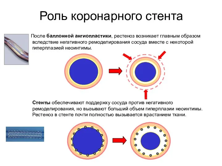 После баллонной ангиопластики, рестеноз возникает главным образом вследствие негативного ремоделирования