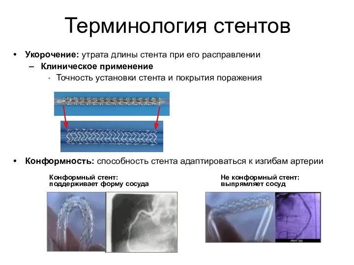 Укорочение: утрата длины стента при его расправлении Клиническое применение Точность