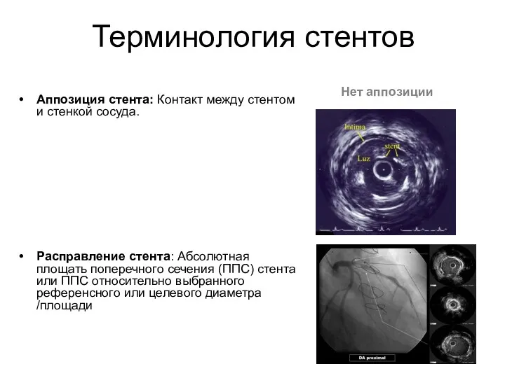 Аппозиция стента: Контакт между стентом и стенкой сосуда. Расправление стента: