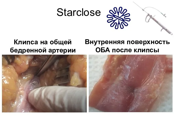 Клипса на общей бедренной артерии Внутренняя поверхность ОБА после клипсы Starclose