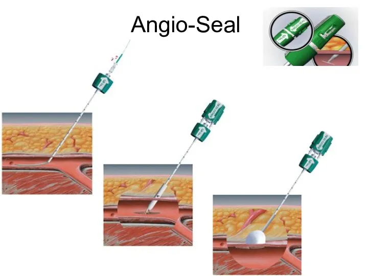 Angio-Seal