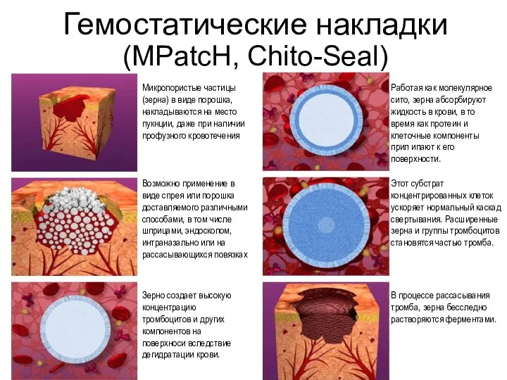 Гемостатические накладки (MPatcH, Chito-Seal) Микропористые частицы (зерна) в виде порошка,