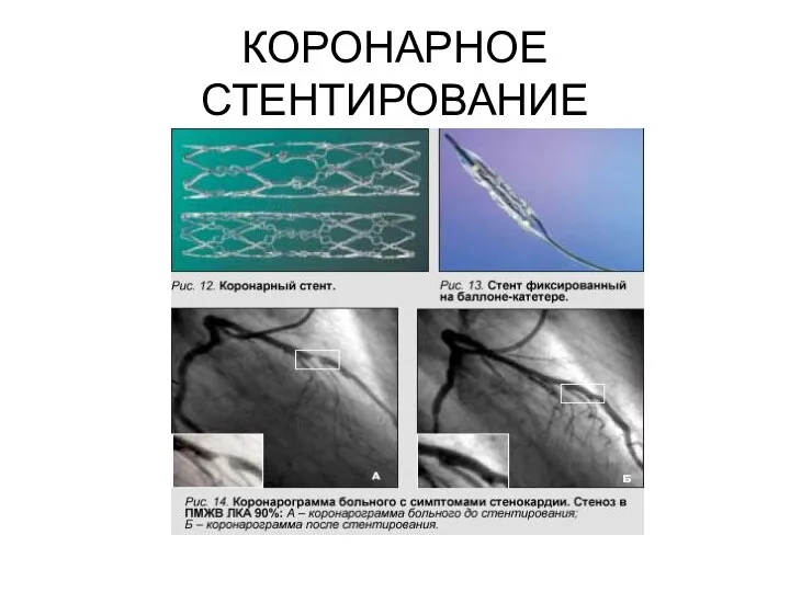 КОРОНАРНОЕ СТЕНТИРОВАНИЕ