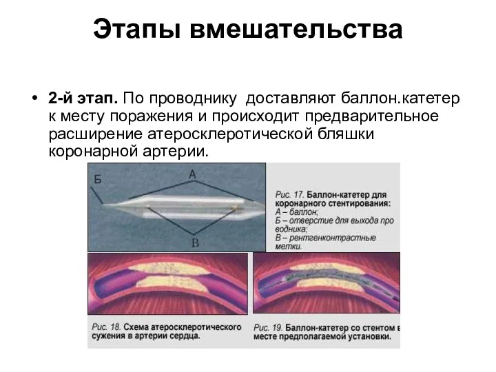 Этапы вмешательства 2-й этап. По проводнику доставляют баллон.катетер к месту