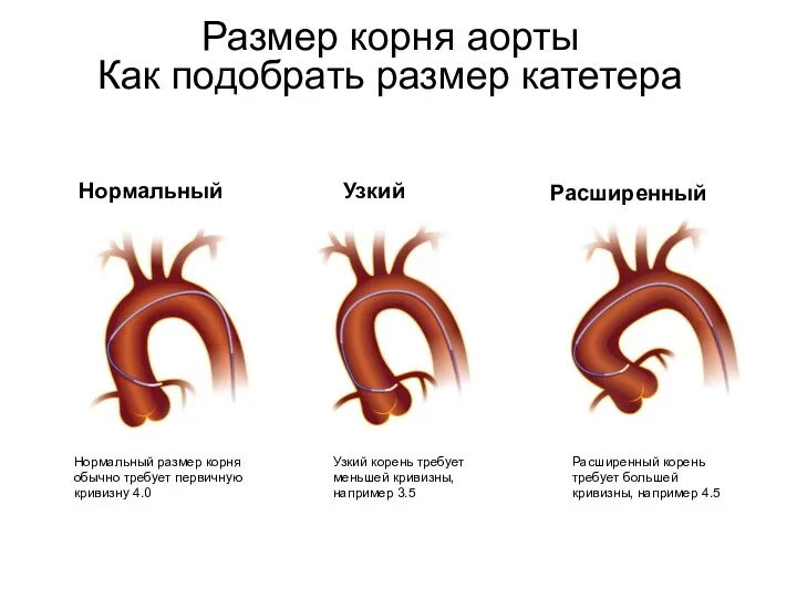 Нормальный Узкий Расширенный Нормальный размер корня обычно требует первичную кривизну