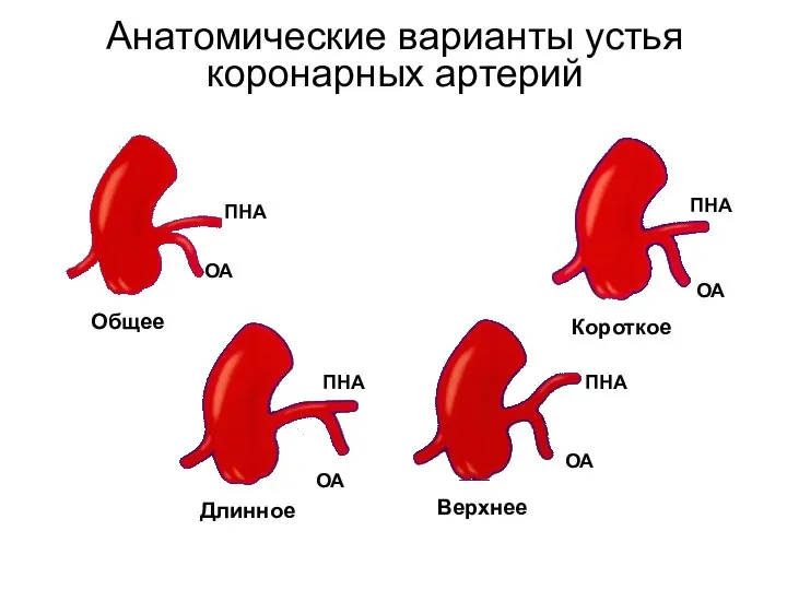Анатомические варианты устья коронарных артерий Общее Короткое Длинное Верхнее ПНА