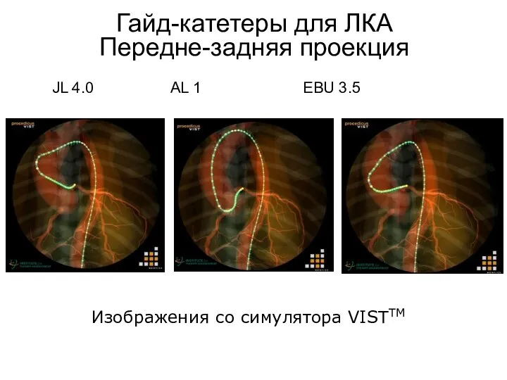 JL 4.0 AL 1 EBU 3.5 Изображения со симулятора VISTTM Гайд-катетеры для ЛКА Передне-задняя проекция