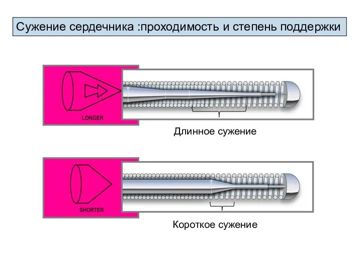 Сужение сердечника :проходимость и степень поддержки Длинное сужение Короткое сужение