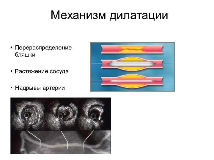 Механизм дилатации Перераспределение бляшки Растяжение сосуда Надрывы артерии