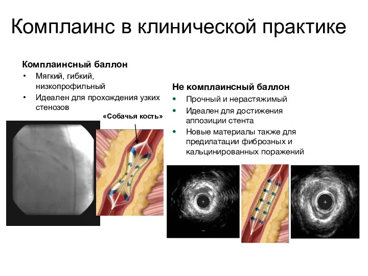 Комплаинс в клинической практике Комплаинсный баллон Мягкий, гибкий, низкопрофильный Идеален