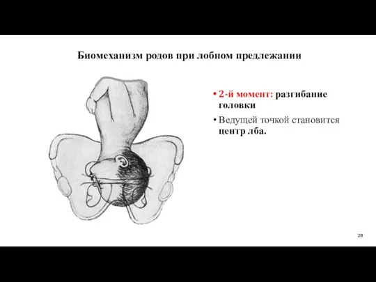 Биомеханизм родов при лобном предлежании 2-й момент: разгибание головки Ведущей точкой становится центр лба.
