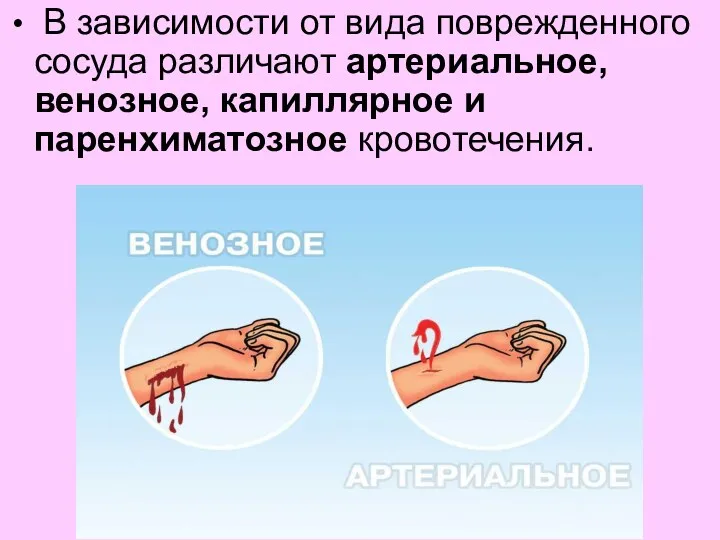 В зависимости от вида поврежденного сосуда различают артериальное, венозное, капиллярное и паренхиматозное кровотечения.