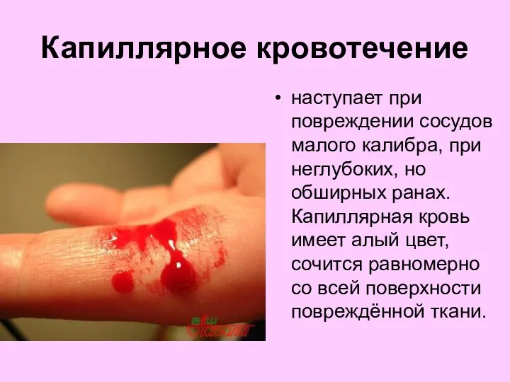 Капиллярное кровотечение наступает при повреждении сосудов малого калибра, при неглубоких, но обширных ранах.