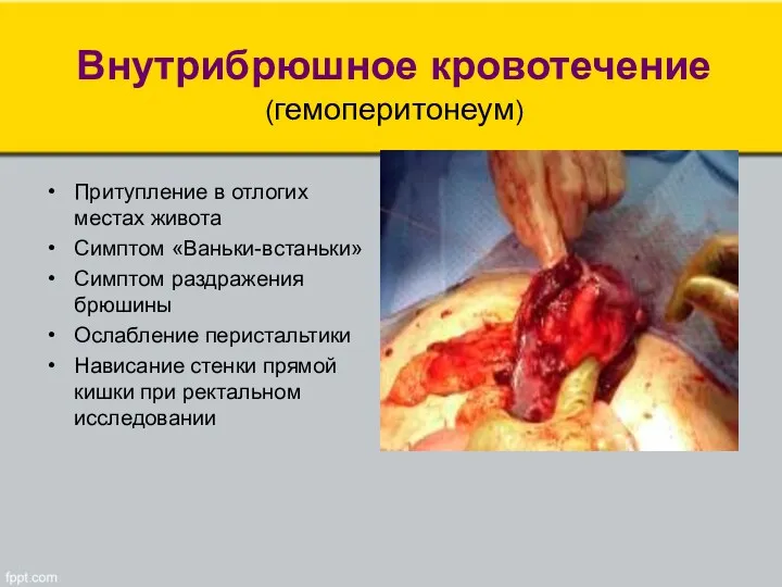 Внутрибрюшное кровотечение (гемоперитонеум) Притупление в отлогих местах живота Симптом «Ваньки-встаньки»