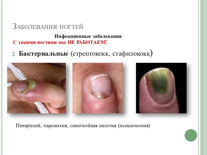 Заболевания ногтей Инфекционные заболевания С такими ногтями мы НЕ РАБОТАЕМ! Бактериальные (стрептококк, стафилококк)